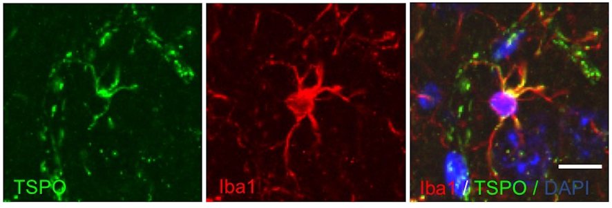 Activation of microglia with expression of TSPO